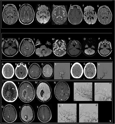 Posterior Reversible Encephalopathy Syndrome and Reversible Cerebral Vasoconstriction Syndrome: Clinical and Radiological Considerations